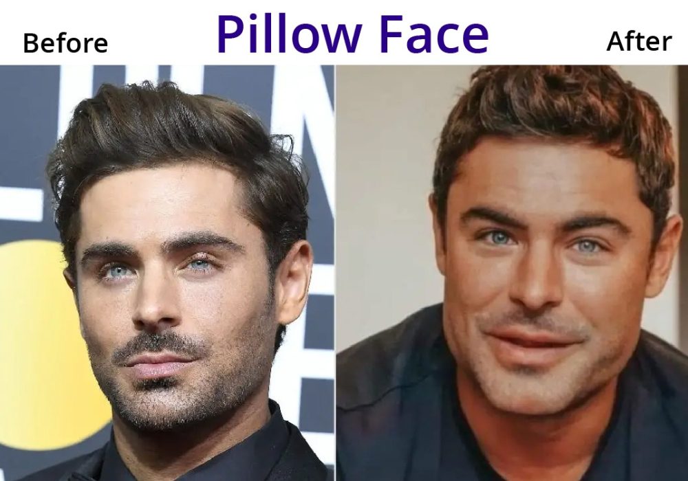 Pillow Face Filler